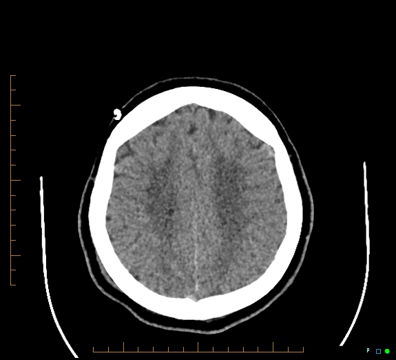 Cerebral fat embolism (Radiopaedia 85521-101220 Axial non-contrast 46).jpg