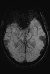 File:Cerebral hemorrhagic contusions- temporal evolution (Radiopaedia 40224-42757 Axial SWI 14).png
