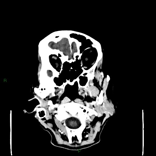 Cerebral metastases - breast primary (Radiopaedia 77653-89857 Axial C+ delayed 14).jpg