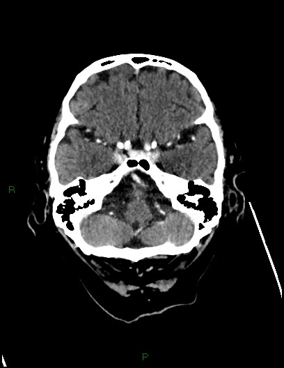 File:Cerebral metastases - ependymal and parenchymal (Radiopaedia 79877-93131 Axial C+ delayed 17).jpg
