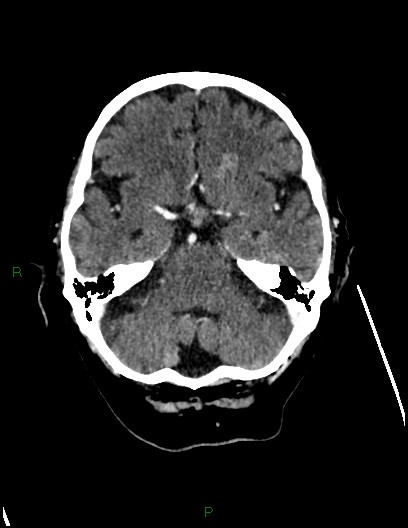 Cerebral metastases - ependymal and parenchymal (Radiopaedia 79877-93131 Axial C+ delayed 23).jpg