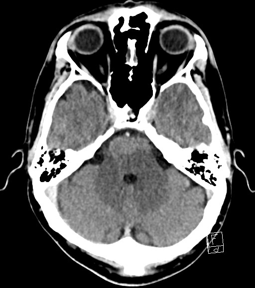 Cerebral metastases - testicular choriocarcinoma (Radiopaedia 84486-99855 Axial C+ delayed 40).jpg
