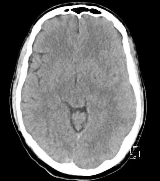 Cerebral metastases - testicular choriocarcinoma (Radiopaedia 84486-99855 Axial non-contrast 32).jpg