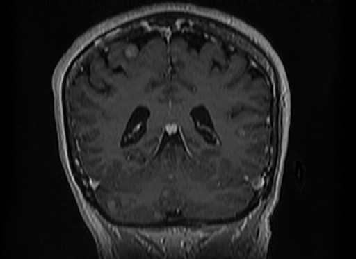 Cerebral metastases from lung cancer with amyloid angiopathy and cerebellopontine angle meningioma (Radiopaedia 74306-85191 Coronal T1 C+ 43).jpg