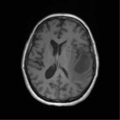 Cerebral metastasis mimicking glioblastoma (Radiopaedia 69155-78937 Axial T1 38).png