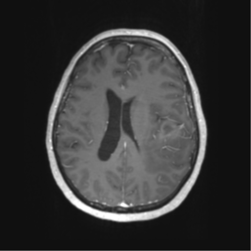 Cerebral metastasis mimicking glioblastoma (Radiopaedia 69155-78937 Axial T1 C+ 42).png