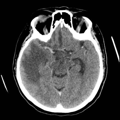 Cerebral metastasis to basal ganglia (Radiopaedia 81568-95412 Axial C+ delayed 25).png