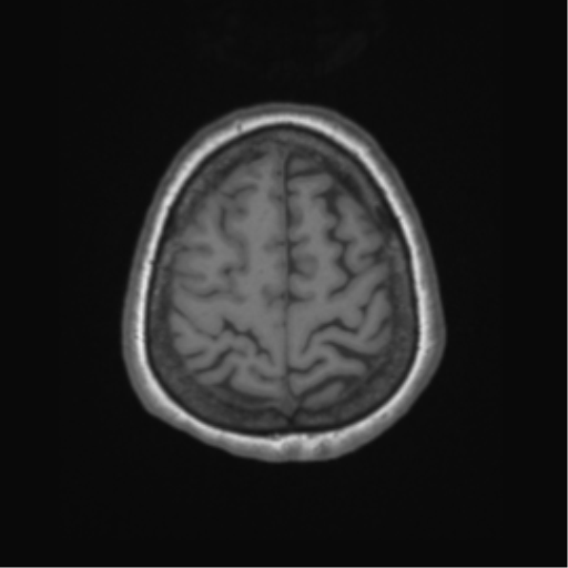 File:Cerebral metastasis to basal ganglia (Radiopaedia 81568-95413 Axial T1 63).png