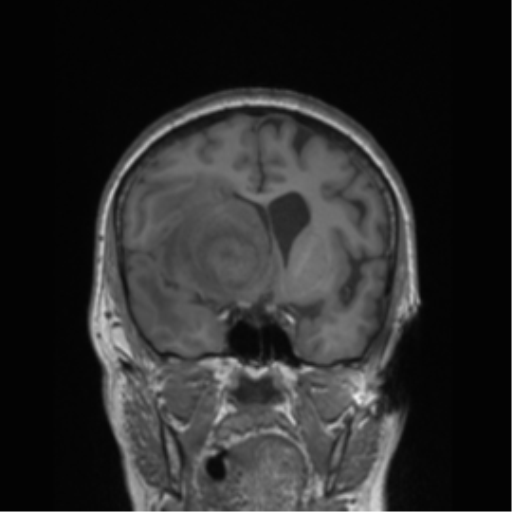 Cerebral metastasis to basal ganglia (Radiopaedia 81568-95413 Coronal T1 37).png
