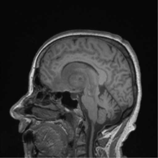 Cerebral metastasis to basal ganglia (Radiopaedia 81568-95413 Sagittal T1 40).png