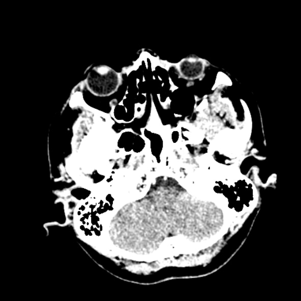 Cerebral ring enhancing lesions - cerebral metastases (Radiopaedia 44922-48818 B 49).jpg