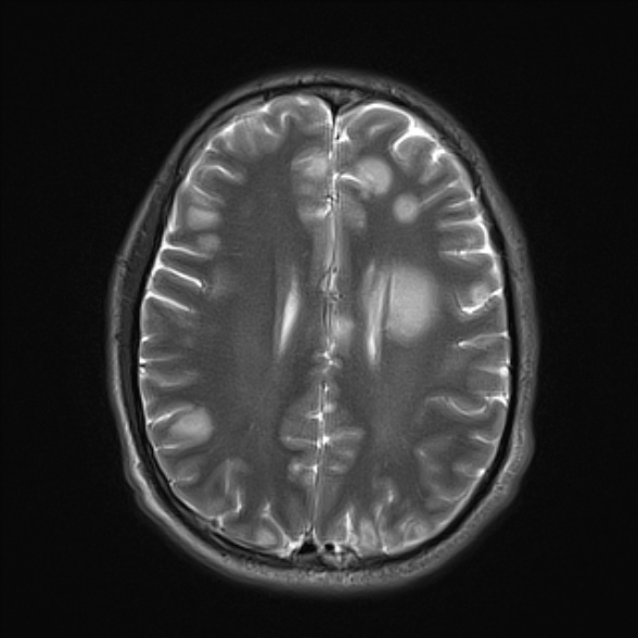 File:Cerebral toxoplasmosis (Radiopaedia 53993-60132 Axial T2 18).jpg