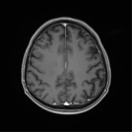 Cerebral toxoplasmosis (Radiopaedia 54575-60804 Axial T1 C+ 40).png