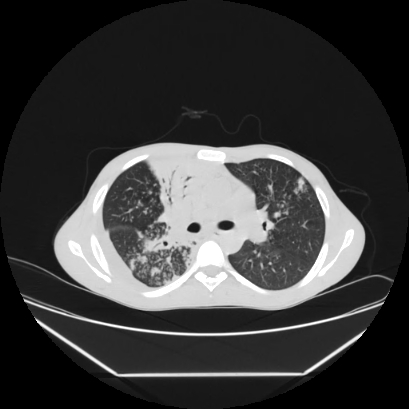 Cerebral tuberculoma (Radiopaedia 80829-94318 Axial lung window 69).jpg