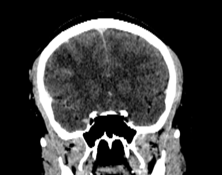 Cerebral venous hemorrhagic infarct from venous sinus thrombosis (Radiopaedia 55433-61883 Coronal C+ delayed 26).jpg