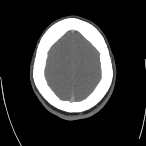 Cerebral venous infarct related to dural venous sinus thromboses (Radiopaedia 35292-36804 Axial C+ delayed 41).png