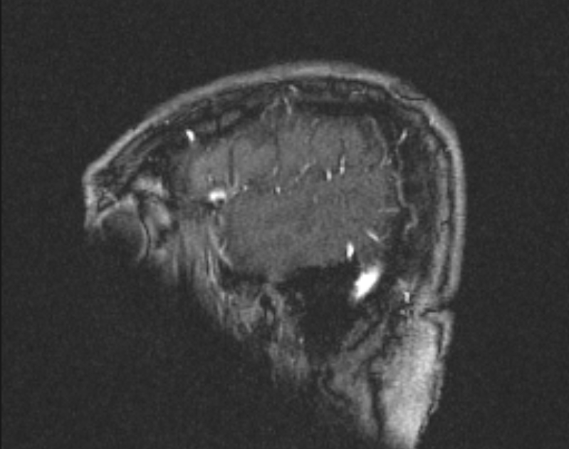 Cerebral venous infarction (Radiopaedia 65166-74176 Sagittal TOF 64).jpg