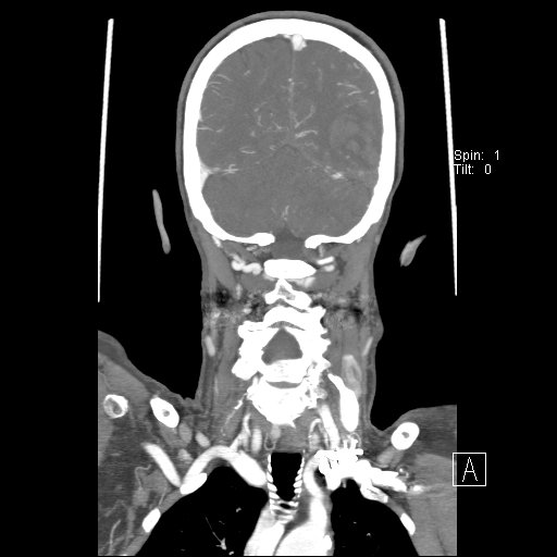 Cerebral venous infarction with hemorrhage (Radiopaedia 65343-74396 B 209).jpg