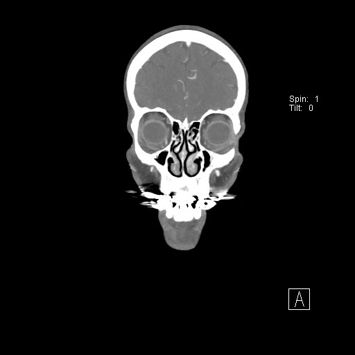 Cerebral venous infarction with hemorrhage (Radiopaedia 65343-74396 B 46).jpg