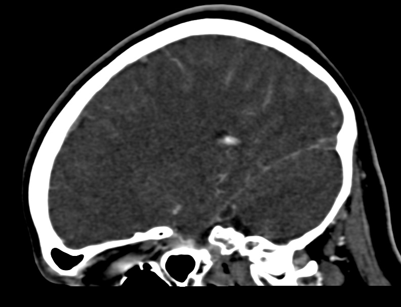 Cerebral venous sinus thrombosis (Radiopaedia 59224-66646 Sagittal C+ delayed 38).jpg
