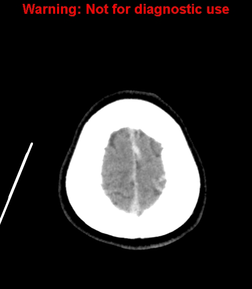 File:Cerebral venous thrombosis (Radiopaedia 37224-38992 Axial non-contrast 27).jpg