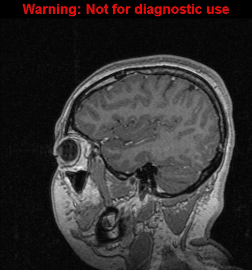 File:Cerebral venous thrombosis (Radiopaedia 37224-39208 Sagittal T1 C+ 38).jpg