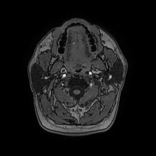 File:Cerebral venous thrombosis with secondary intracranial hypertension (Radiopaedia 89842-106957 Axial T1 C+ 12).jpg