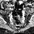 File:Cervical adenocarcinoma (Radiopaedia 65011-73985 Axial ADC 27).jpg