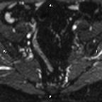 Cervical adenocarcinoma (Radiopaedia 65011-73985 Axial DWI 70).jpg