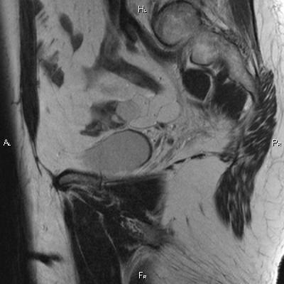 File:Cervical adenocarcinoma (Radiopaedia 65011-73985 Sagittal T2 23).jpg