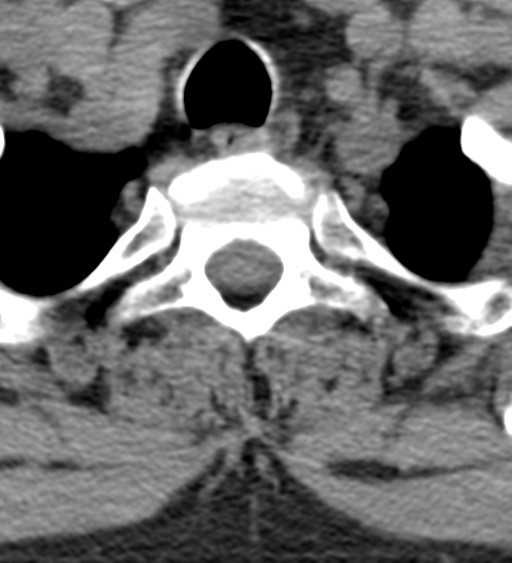 File:Cervical canal stenosis - OPLL and osteophytes (Radiopaedia 47329-51910 Axial non-contrast 58).png