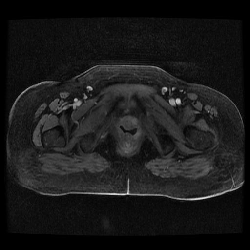 Cervical carcinoma (Radiopaedia 70924-81132 Axial T1 C+ fat sat 115).jpg