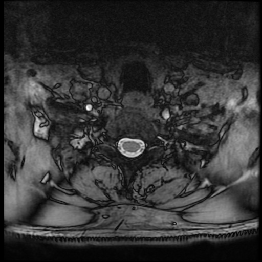 Cervical disc extrusion (Radiopaedia 59074-66364 G 93).jpg