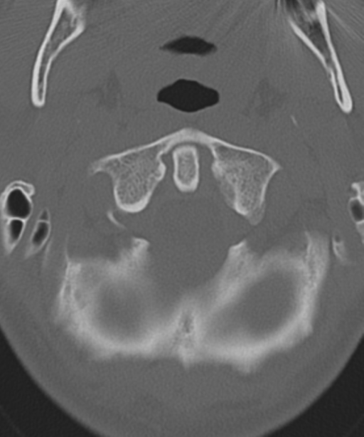 Cervical intercalary bone (Radiopaedia 35211-36748 Axial bone window 13).png