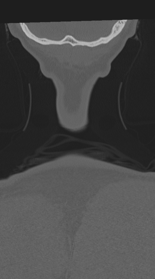 Cervical intercalary bone (Radiopaedia 35211-36748 Coronal bone window 84).png