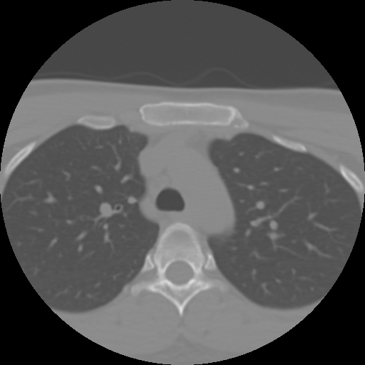 Cervical rib (Radiopaedia 71110-81363 Axial non-contrast 65).jpg
