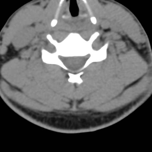 Cervical schwannoma (Radiopaedia 57979-64974 Axial non-contrast 41).png