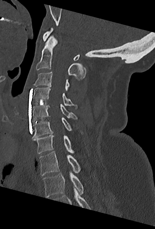 Cervical spine ACDF loosening (Radiopaedia 48998-54070 Sagittal bone window 42).png
