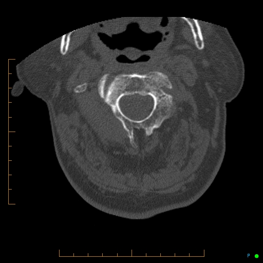 Cervical spine fracture - ankylosing spondylitis (Radiopaedia 76835-88706 Axial bone window 52).jpg