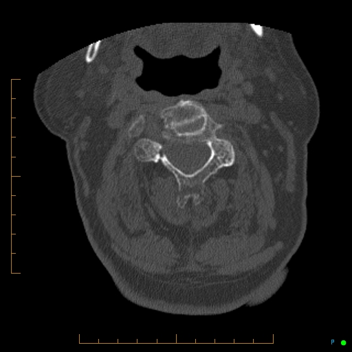 File:Cervical spine fracture - ankylosing spondylitis (Radiopaedia 76835-88706 Axial bone window 75).jpg