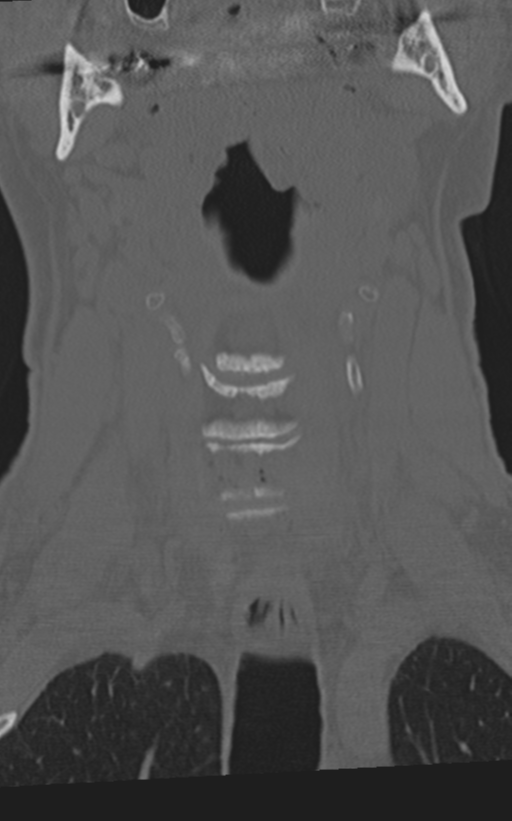 Cervical spine fractures with vertebral artery dissection (Radiopaedia 53296-59268 Coronal bone window 16).png