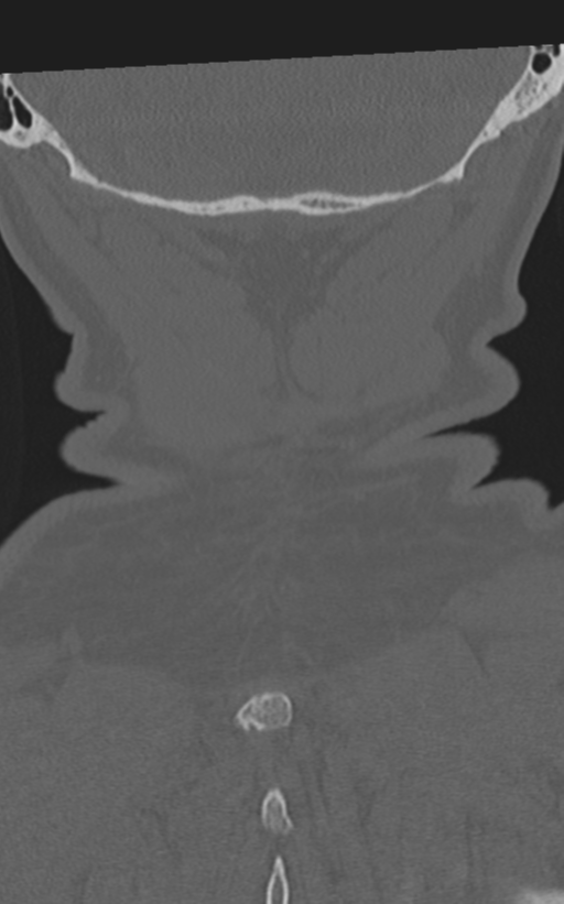 Cervical spine fractures with vertebral artery dissection (Radiopaedia 53296-59268 Coronal bone window 66).png