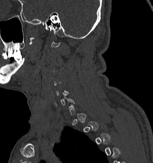 Cervical spine trauma with tear drop fracture and perched facet joint (Radiopaedia 53989-60127 Sagittal bone window 9).jpg