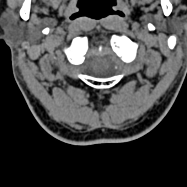 Cervical spondylodiscitis (Radiopaedia 28057-29489 Axial non-contrast 15).jpg