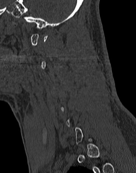 Cervical spondylodiscitis (Radiopaedia 28057-29489 Sagittal bone window 20).jpg