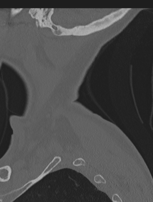 Cervical spondylolysis (Radiopaedia 49616-54811 Sagittal bone window 4).png