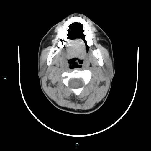 File:Cervical thymic cyst (Radiopaedia 88632-105335 Axial non-contrast 87).jpg