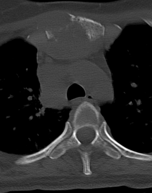 Cervical tuberculous spondylitis (Radiopaedia 39149-41365 Axial bone window 61).png