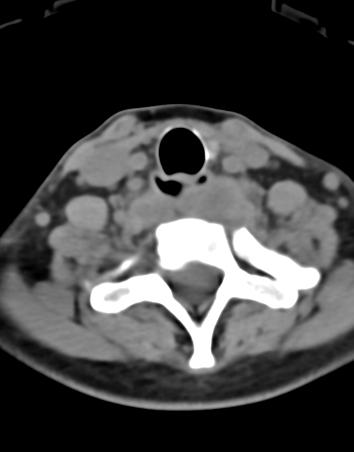Cervical tuberculous spondylitis (Radiopaedia 39149-41365 Axial non-contrast 42).png