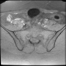 File:Cesarean scar ectopic pregnancy (Radiopaedia 77286-89362 Axial T1 fat sat 4).jpg
